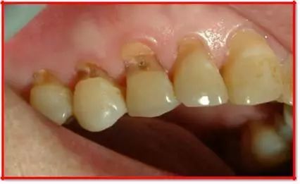 还在这样刷牙吗？当心楔状缺损找上门！